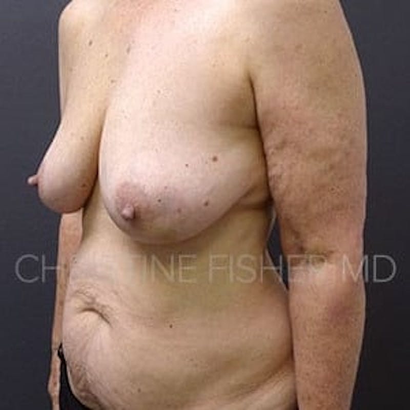 Areola Tattooing Before & After Gallery - Patient 186152 - Image 3