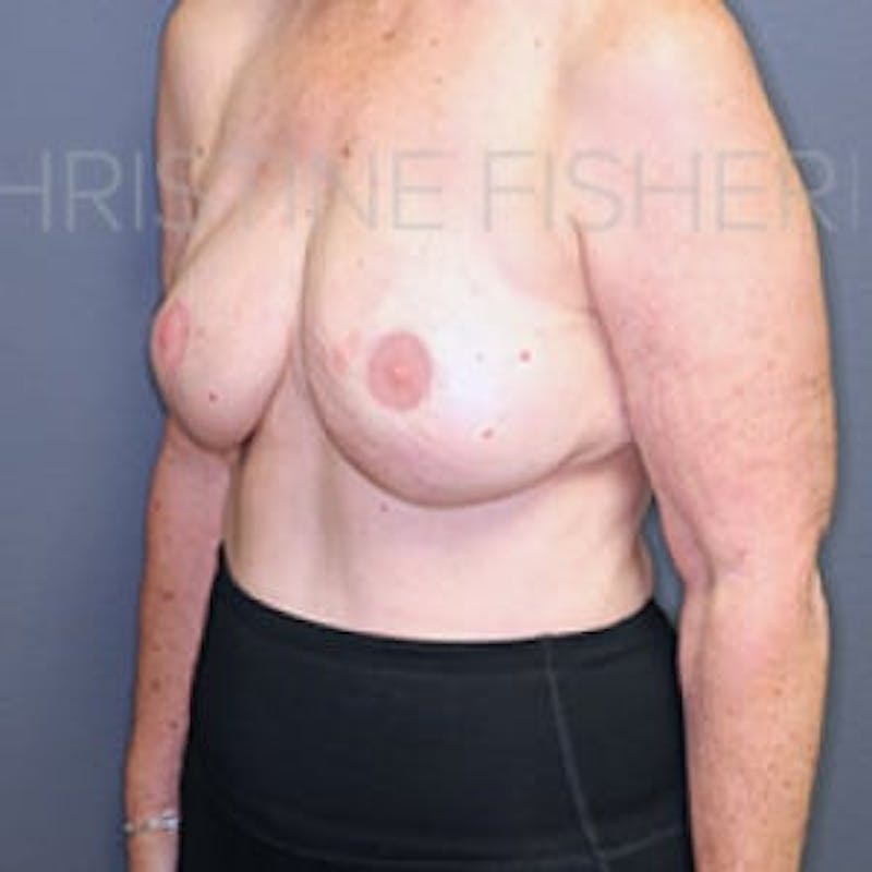 Areola Tattooing Before & After Gallery - Patient 186152 - Image 4