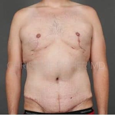 Male Breast Reduction Before & After Gallery - Patient 226707 - Image 2