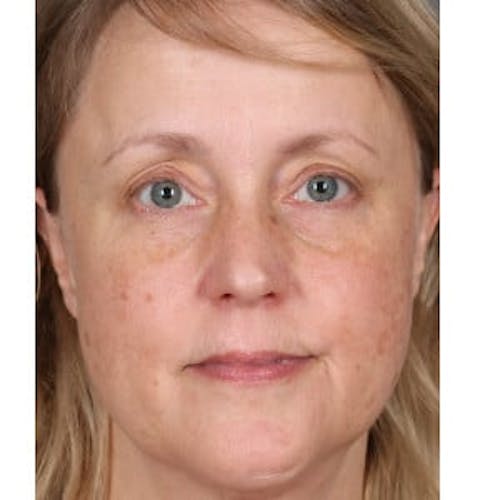 Before procedure image for Broad Band Light