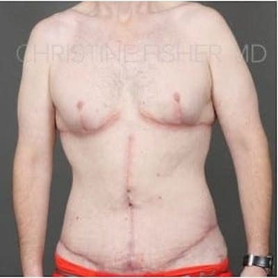 Male Breast Reduction Before & After Gallery - Patient 851935 - Image 2
