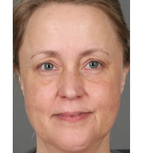 After procedure image for Broad Band Light