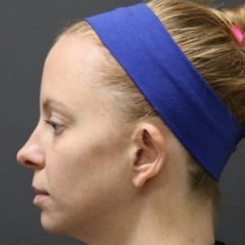 HALO™ Before & After Gallery - Patient 157087 - Image 1