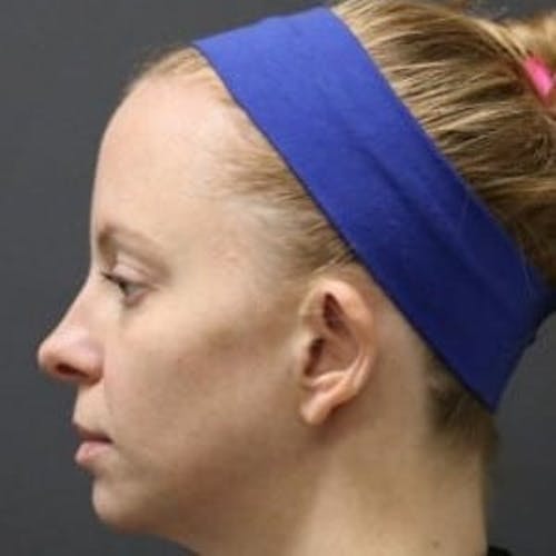 Before procedure image for HALO™