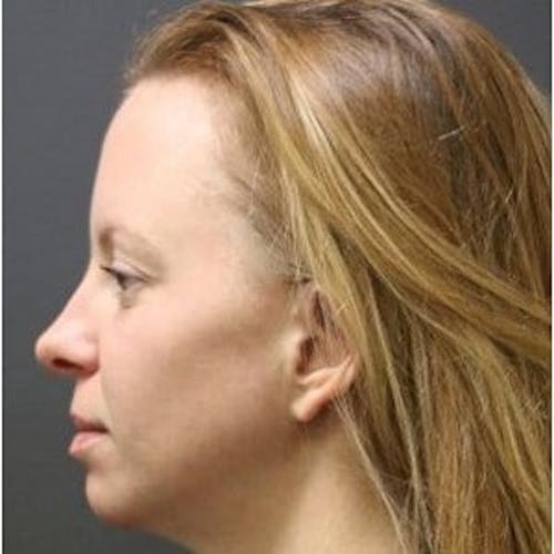 After procedure image for HALO™