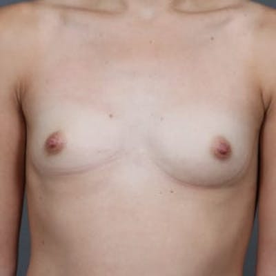 Breast Augmentation Before & After Gallery - Patient 935251 - Image 1