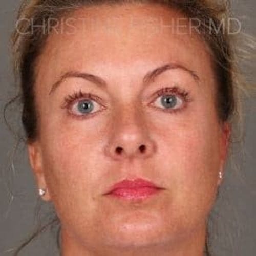 Before procedure image for HALO™