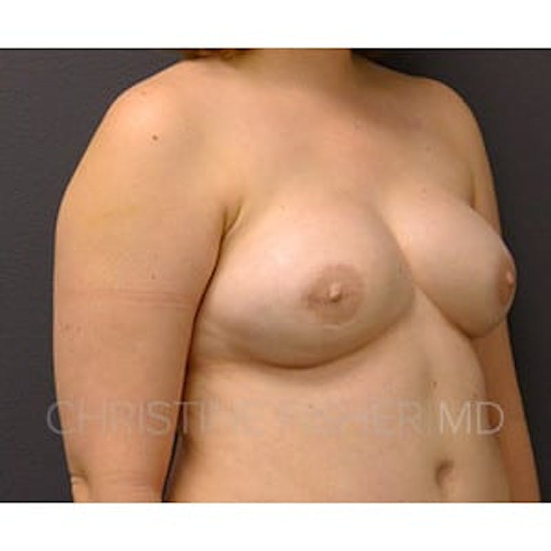Areola Tattooing Before & After Gallery - Patient 417077 - Image 6