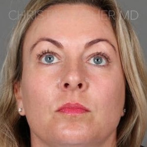 After procedure image for HALO™