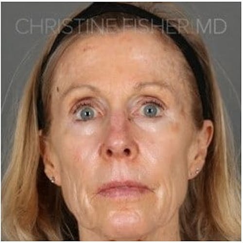 Before procedure image for HALO™