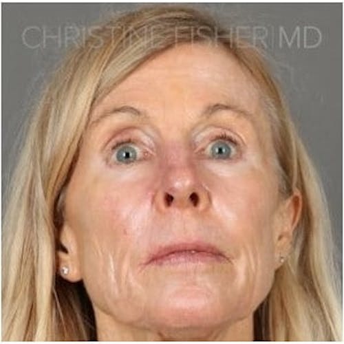 After procedure image for HALO™