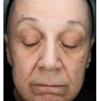 HALO™ Before & After Gallery - Patient 160936 - Image 1