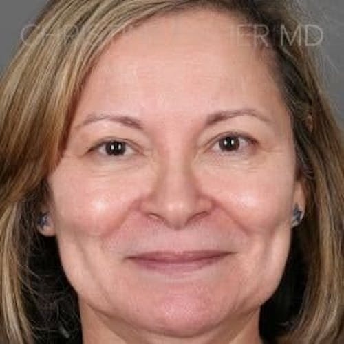 Before procedure image for Broad Band Light