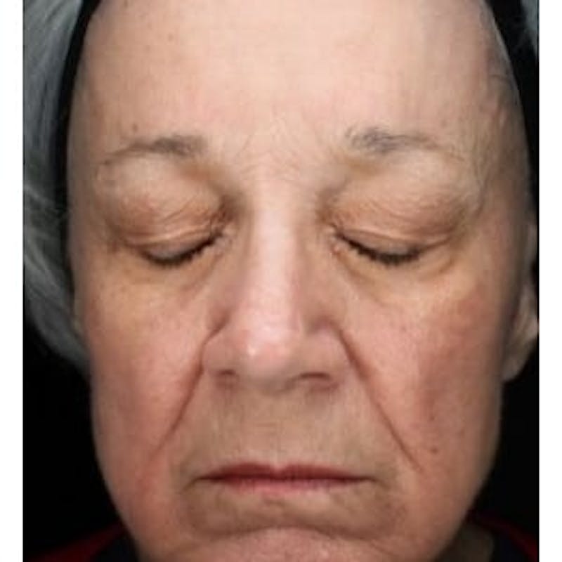 HALO™ Before & After Gallery - Patient 160936 - Image 2