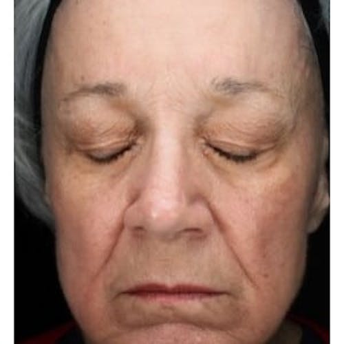 After procedure image for HALO™