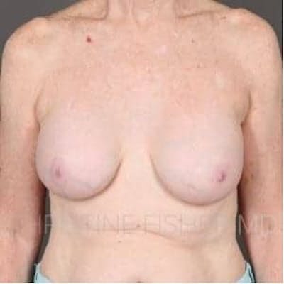 Implant Removal Before & After Gallery - Patient 676405 - Image 1