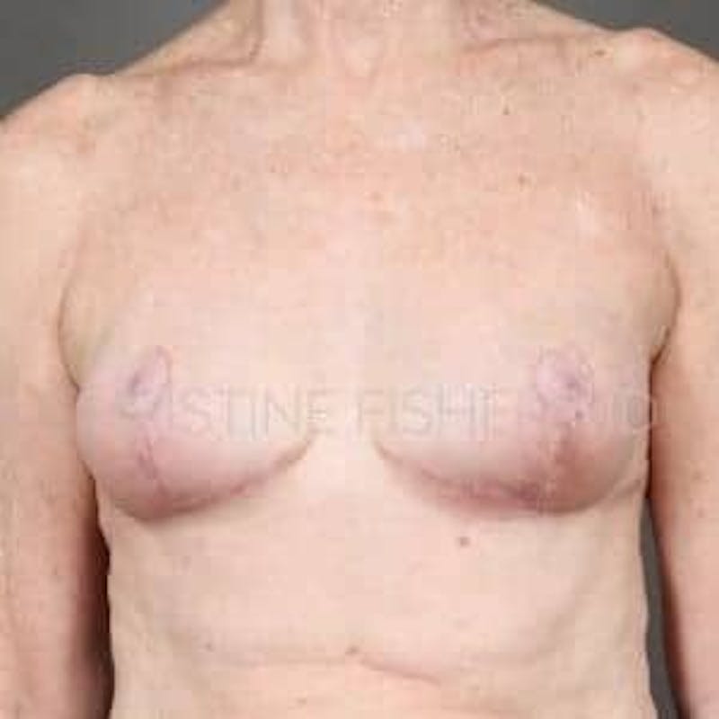 Implant Removal Before & After Gallery - Patient 676405 - Image 2