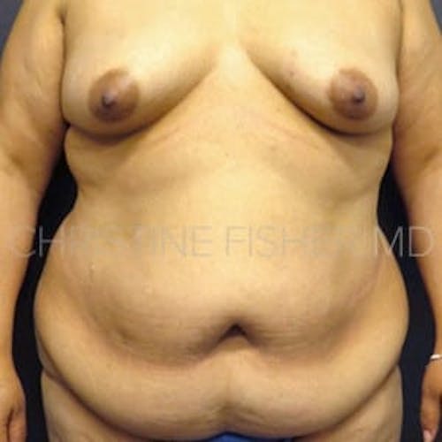 Before procedure image for Areola Tattooing
