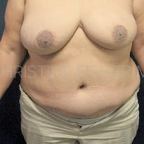 After procedure image for Areola Tattooing