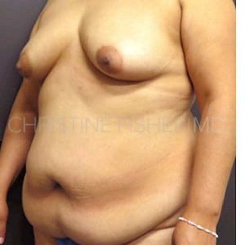Areola Tattooing Before & After Gallery - Patient 305960 - Image 3