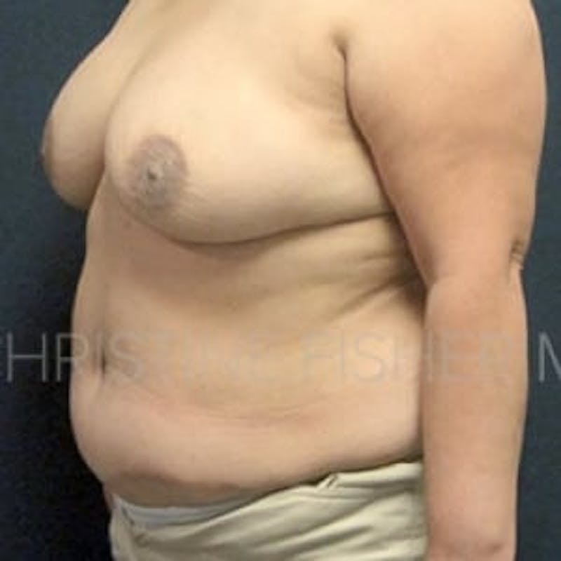 Areola Tattooing Before & After Gallery - Patient 305960 - Image 4