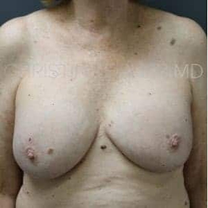 Breast Lift Before & After Gallery - Patient 196399 - Image 1
