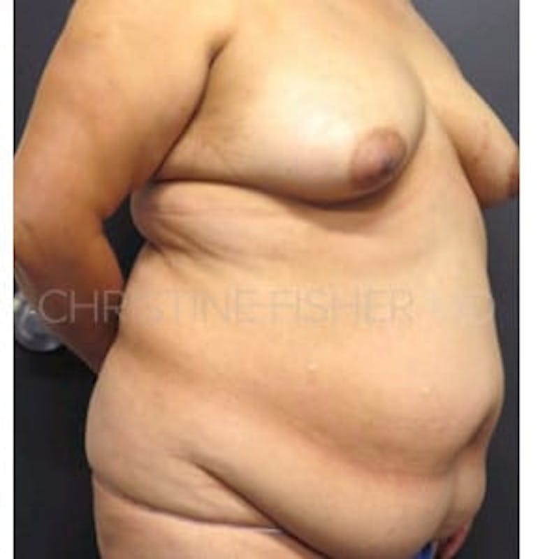 Areola Tattooing Before & After Gallery - Patient 305960 - Image 5