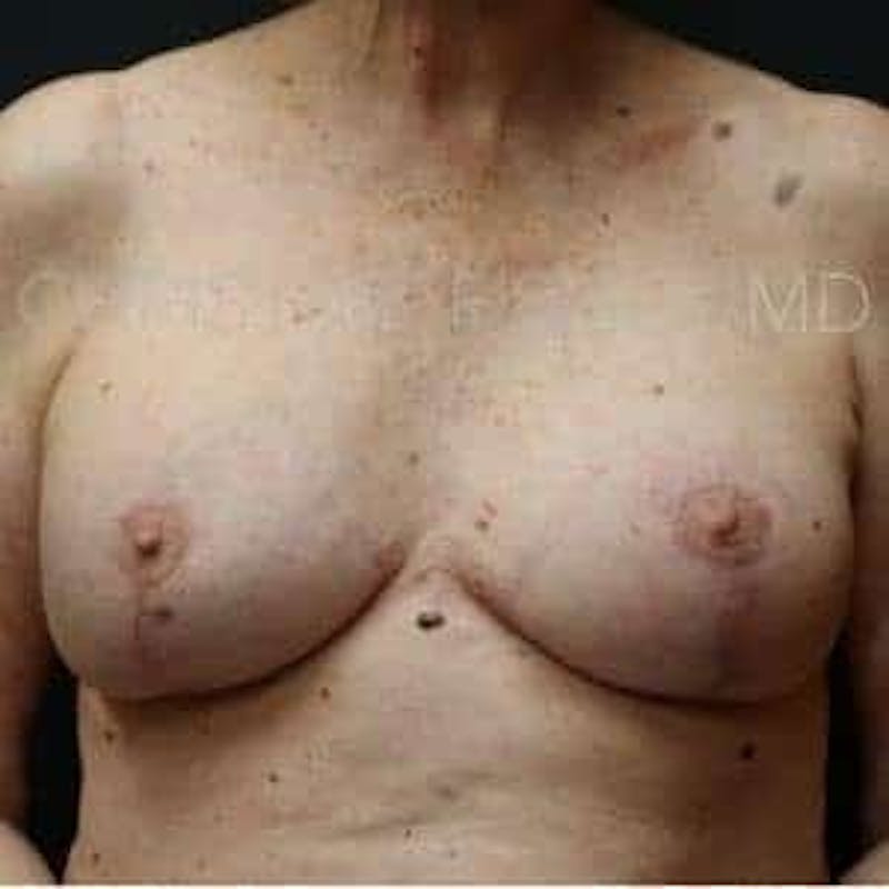 Breast Lift Before & After Gallery - Patient 196399 - Image 2
