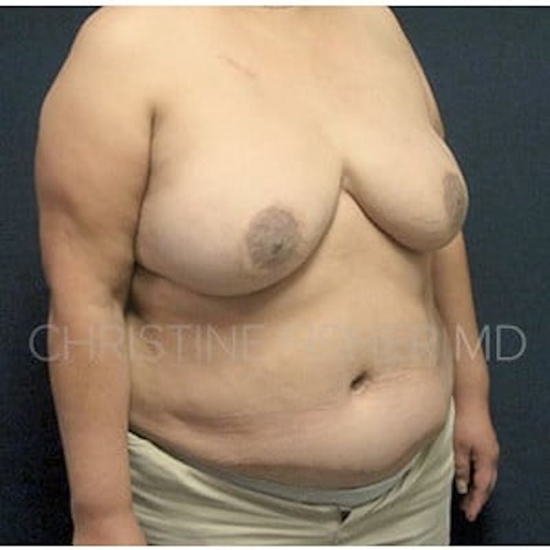 Areola Tattooing Before & After Gallery - Patient 305960 - Image 6