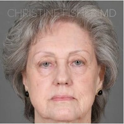 HALO™ Before & After Gallery - Patient 947971 - Image 1