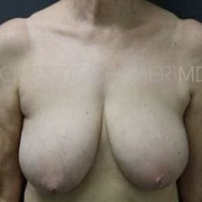 Breast Reduction Before & After Gallery - Patient 230409 - Image 1