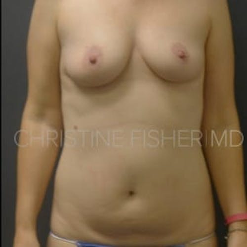Before procedure image for Areola Tattooing