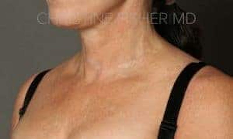 HALO™ Before & After Gallery - Patient 316719 - Image 3