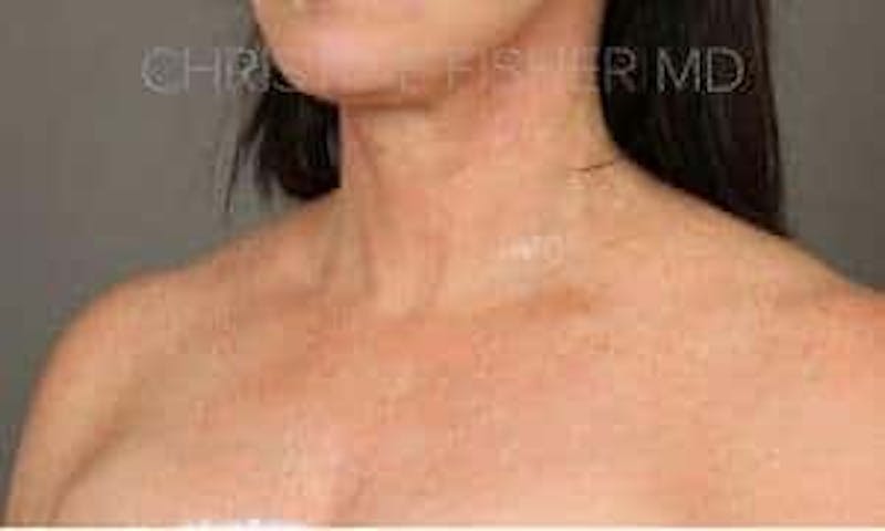 HALO™ Before & After Gallery - Patient 316719 - Image 4