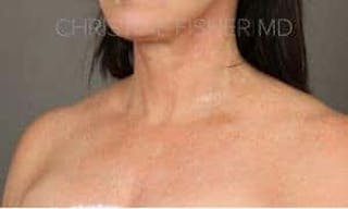 HALO™ Before & After Gallery - Patient 316719 - Image 4