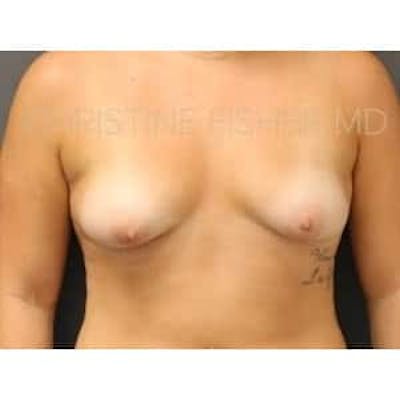 Breast Augmentation Before & After Gallery - Patient 227074 - Image 1