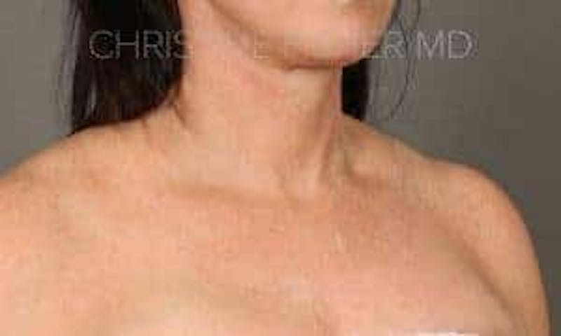 HALO™ Before & After Gallery - Patient 316719 - Image 6