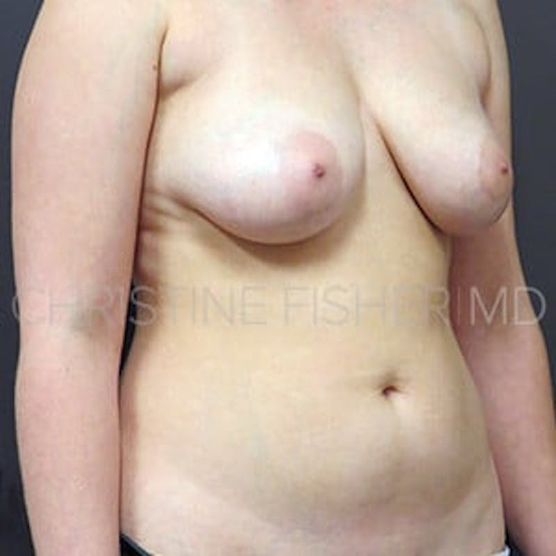 Areola Tattooing Before & After Gallery - Patient 213701 - Image 5