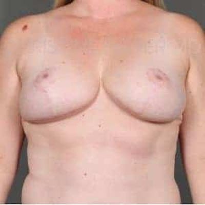 Breast Reduction Before & After Gallery - Patient 304817 - Image 1