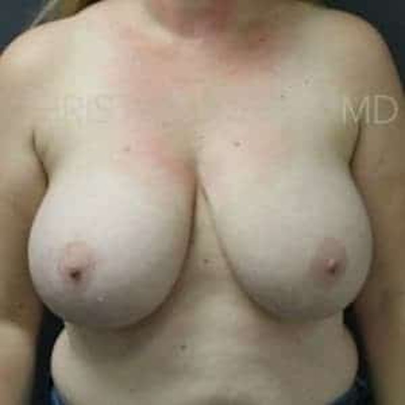 Breast Reduction Before & After Gallery - Patient 304817 - Image 1