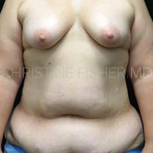 Before procedure image for Areola Tattooing
