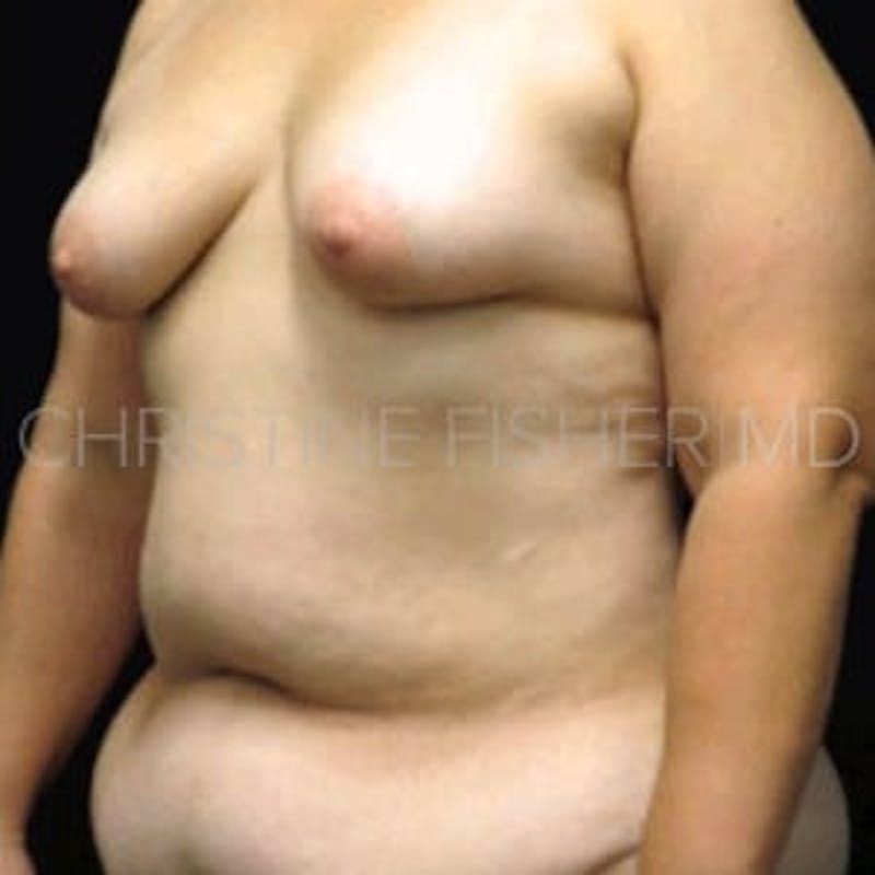 DIEP Flap Before & After Gallery - Patient 368077 - Image 3