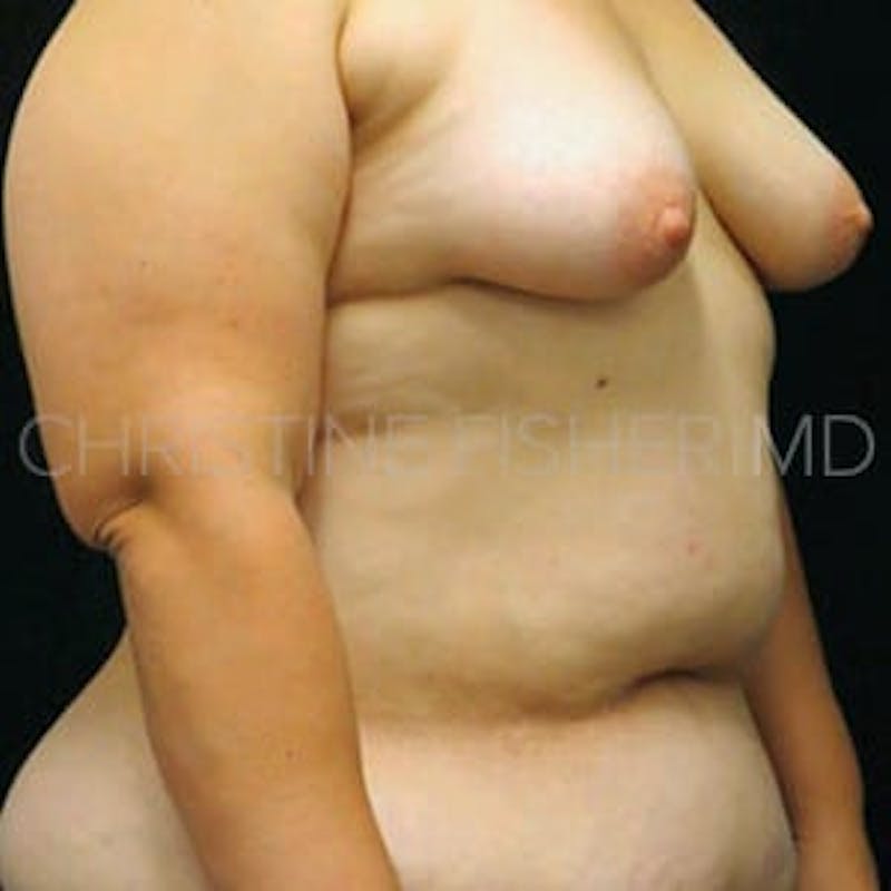 DIEP Flap Before & After Gallery - Patient 368077 - Image 5