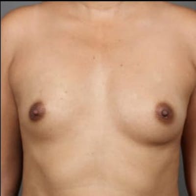 Breast Augmentation Before & After Gallery - Patient 208124 - Image 1