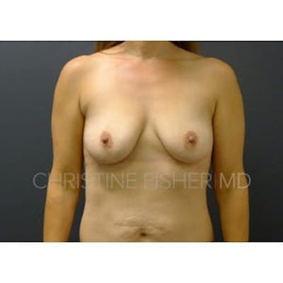 Breast Augmentation Before & After Gallery - Patient 247282 - Image 1