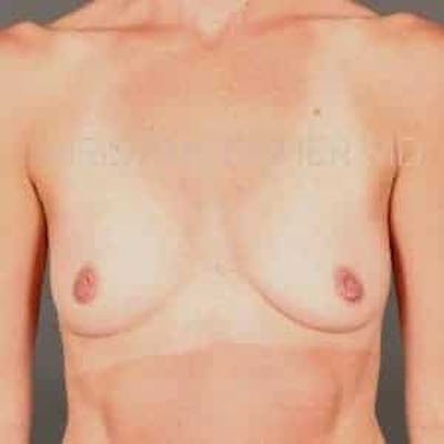 Breast Augmentation Before & After Gallery - Patient 360890 - Image 1