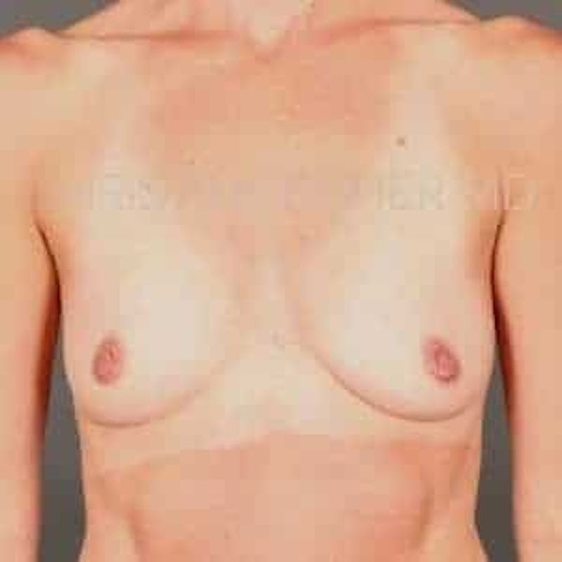 Breast Augmentation Before & After Gallery - Patient 360890 - Image 1