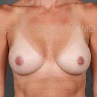 Breast Augmentation Before & After Gallery - Patient 360890 - Image 2