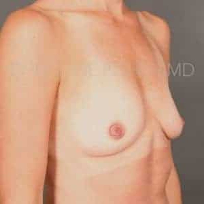 Breast Augmentation Before & After Gallery - Patient 360890 - Image 3