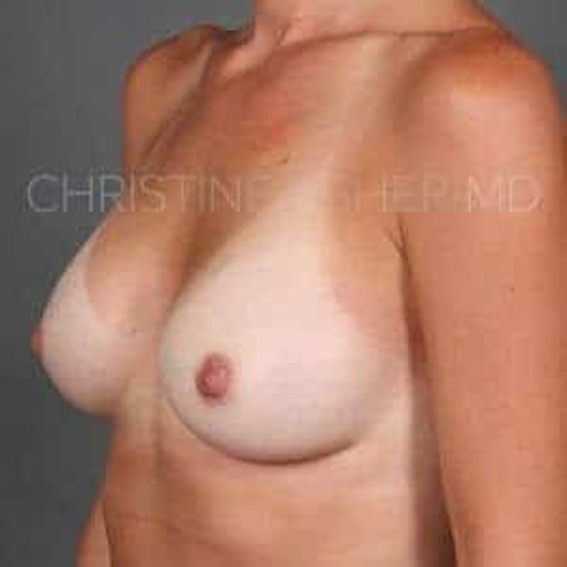 Breast Augmentation Before & After Gallery - Patient 360890 - Image 6